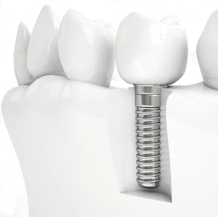 Implanturile dentare au rang mai bine clinici
