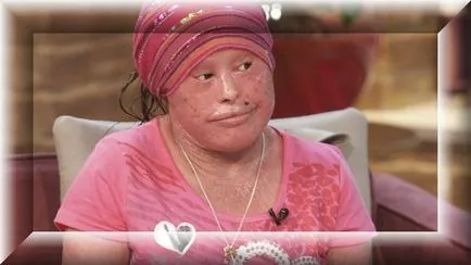 Harlequin ichthyosis - tratament și fotografie (Harlequin) Harlequin ichthyosis - Tratamentul și fotografii