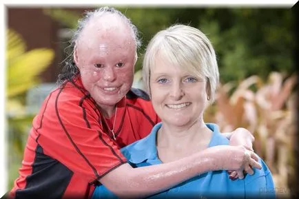 Harlequin ichthyosis - tratament și imagine (foto) Harlequin ichthyosis - Tratamentul și fotografii