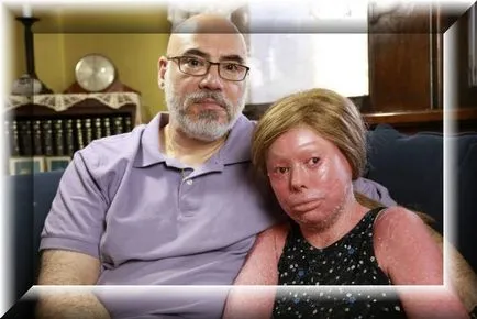 Harlequin ichthyosis - tratament și imagine (foto) Harlequin ichthyosis - Tratamentul și fotografii