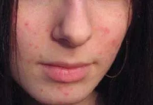 Cum de a elimina rapid roseata de la acnee și inflamație