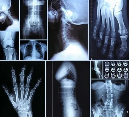 Cât de des și de câte ori se poate face o radiografie (poate) Cât de des și de câte ori se poate face o radiografie