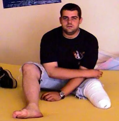 Așa cum omul a pierdut piciorul, am primit un gust, și a început să taie propriile membrelor (foto) - (gust) Așa cum omul a pierdut piciorul, am primit un gust, și a început să taie propriile membrelor (foto) -