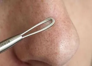 Cum de a elimina punctele negre de pe nas metode eficiente de tratament (prin intermediul unor puncte negre) Cum de a elimina puncte negre pe nas tratamente eficiente