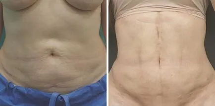 Cum de a elimina grasimea de pe spate și lateral rapid (spate) Cum de a elimina grasimea de pe spate și lateral rapid