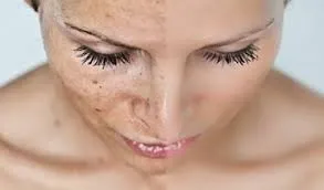Crema Ahromin - Comentarii și beneficii (cremă) Crema Ahromin - comentarii și beneficii