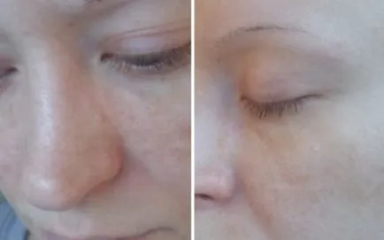 Crema de pete de vârstă Ahromin comentarii, fotografii înainte și după crema primeneniyavse eficiente Ahromin