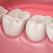 Tratamentul bolilor gingivale la domiciliu condiții de spălare, unguente si pastile