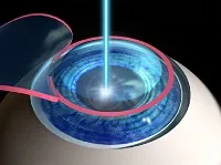 Pro corectarea vederii cu laser și contra de recuperare chirurgie