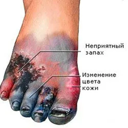remedii populare Tratamentul cangrenă în casă (home) Tratamentul gangrenei remedii populare la domiciliu