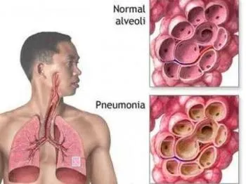 Tratamentul de remedii populare inflamației pulmonare (populare) inflamație a plămânilor populare remedii de tratament