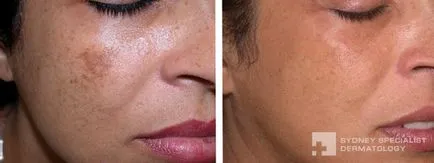 cu laser Fraxel - rezultatele depășesc așteptările