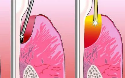 Tratamentul cu laser caracteristicile periodontitei ale procedurii (laser) Tratamentul cu laser de caracteristici parodontită ale procedurii