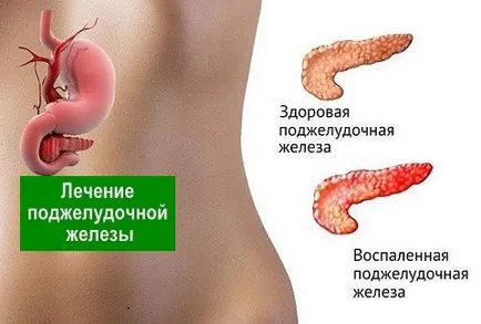 Tratamentul de remedii populare pancreatice - longevitate sănătoasă (tratamentul de remedii populare pancreatice) remedii pancreatice Tratament popular - longevitate sănătos