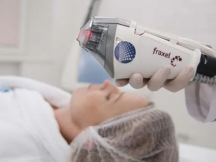 Fraxel laser (Fraxel) ce este, tipurile, principiul de funcționare, avantaje, pret