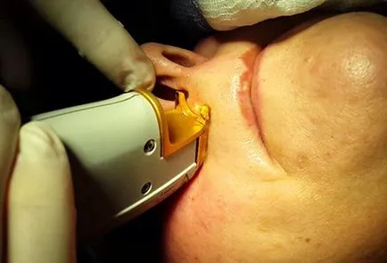 vase de spargere pe fata cauze cu laser îndepărtarea și metode (metode) navele izbucni pe fata provoacă metode de îndepărtare și cu laser