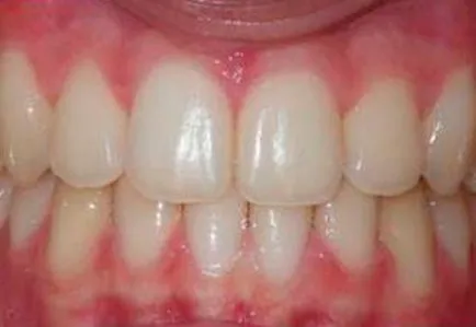 Top Bretele Bretele sau orice alt loc mai bun (cel mai bun) parantezele de sus sau de ceea ce este mai bine pentru a pune aparat dentar