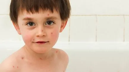 Pot să fac baie copilului cu varicela atunci când se poate scălda copilul dupa varicela (posibil) Pot să fac baie copilului cu varicela atunci când se poate scălda copilul dupa varicela