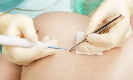 Este posibil pentru a elimina alunițele și modul în care cele mai bune pentru a face în clinică sau acasă (mai bună) Este posibil pentru a elimina alunițele și modul în care cele mai bune pentru a face in clinica sau acasa
