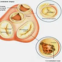 valva aortica 1, 2, 3 grade, tratament, simptome si cauze (esec) valva aortica 1, 2, 3 grade, tratament, simptomele și cauzele