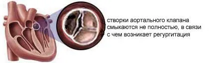 valva aortica 1, 2, 3 grade, tratamentul, simptomele și cauzele (aortic) valva aortica 1, 2, 3 grade, tratament, simptomele și cauzele
