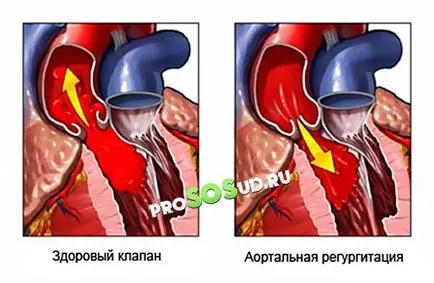 valva aortica 1, 2, 3 grade, tratamentul, simptomele și cauzele (cardiace de lucru valva insuficienta grad aortă de sânge) valva aortica 1, 2, 3 grade, tratament, simptomele și cauzele