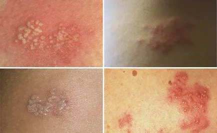 Zona zoster - cauze, simptome, tratament