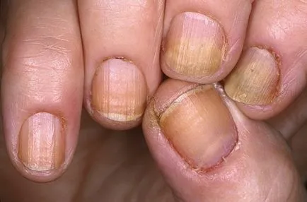 Onycholysis unghiei exfolierii