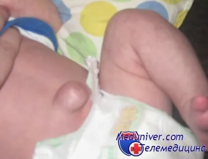 Din ceea ce copilul a bombat tratament buric al hernie ombilicală la copii