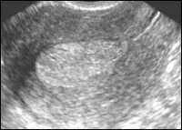 Patologia diagnosticare cu ultrasunete endometrial in practica ginecologice