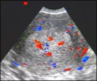 Patologia diagnosticare cu ultrasunete endometrial in practica ginecologice