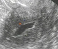 Patologia diagnosticare cu ultrasunete endometrial in practica ginecologice