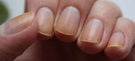 Exfoliaza unghiile cauze, simptome, tratament, consiliere