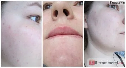 Face peeling acizi din fructe - „coaja de acid acasă, fără arsuri și iritații (acid) Face peeling acizi din fructe - „coaja de acid la domiciliu, fără arsuri și iritații
