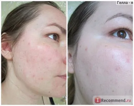 Face peeling acizi din fructe - „coaja de acid acasă, fără arsuri și iritații (acid) Face peeling acizi din fructe - „coaja de acid la domiciliu, fără arsuri și iritații