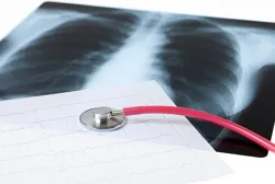 fibroza pulmonara - Tratamentul, cauze, simptome de fibroză pulmonară