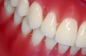 De ce dintii mancarime si gingiile sunt un adult sau un adolescent
