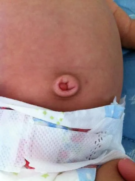 De ce copilul poate fi un buton bombat burta (copilul cele mai multe cazuri) De ce copilul poate fi un buton bombat burta