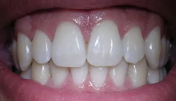 Acoperire dentara ftorlakom ce este și de ce ai nevoie