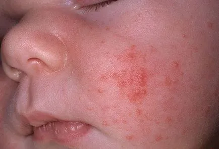 Sudamen pe fața lui la sugari cauze, simptome, tratamente, prevenire (cauza) Sudamen pe fața lui la sugari cauze, simptome, tratamente, prevenire
