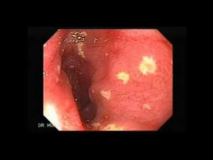 Surface simptome gastro, tratament, cauze