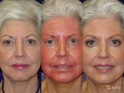 După peeling roșu feței și senzația de mâncărime