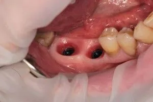 Dental protezare noi tehnologii și tipuri moderne (protetica) Dental protezare noi tehnologii moderne și tipuri