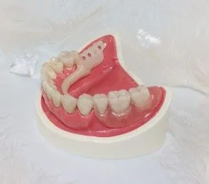 Dental Proteza noi tehnologii moderne și tipuri de (dentare) Dental protezare noi tehnologii moderne și tipuri