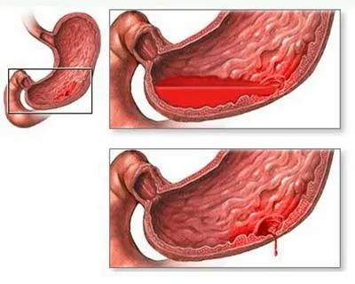Simptome perforate ulcer gastric și stadii de dezvoltare (stomac) Simptome perforate ulcer gastric și la stadiul de dezvoltare