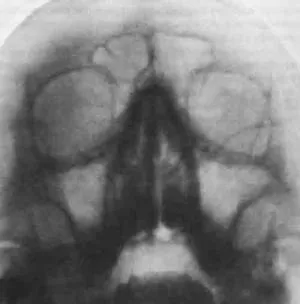 Radiografia sinusurilor paranazale indicatiile pentru raze X decodare PPN (paranazale) Radiografia sinusurilor paranazale indicatiile pentru decodificarea cu raze X PPN