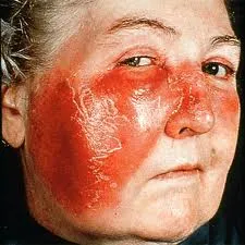 Erizipel - cauze, simptome si remedii populare tratarea erizipelului (tratament remedii populare) Erizipel - cauze, simptome si remedii populare tratarea erizipelului