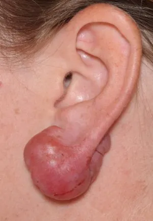 Cicatricile - cheloide, hipertrofice, atrofice