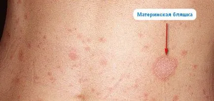 zosterian roz Gibert cauze, simptome, infecțioase sau nu (zona zoster) Pink zosterian Gibert cauze, simptome, infecțioase sau nu
