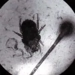 râia sarcoptică la oameni că este, simptome si tratament este infectia se produce